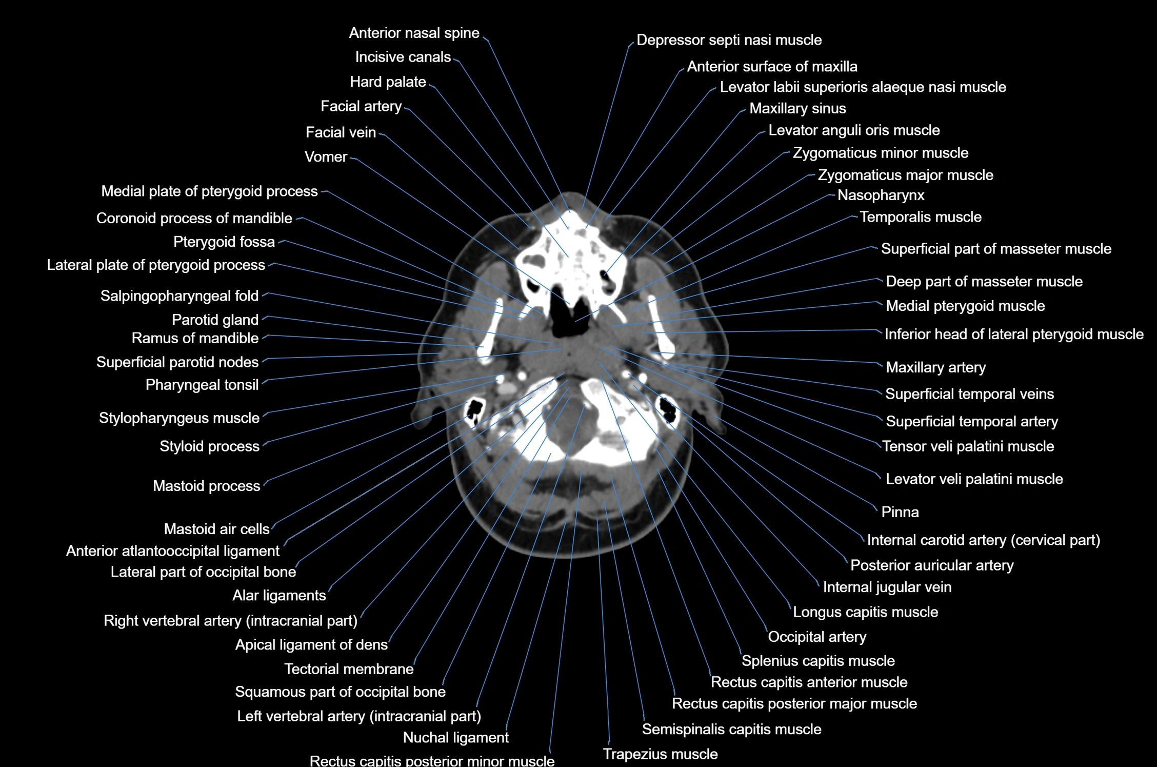 CT Neck axial cross sectional anatomy radiology image-img-00001-00020.webp